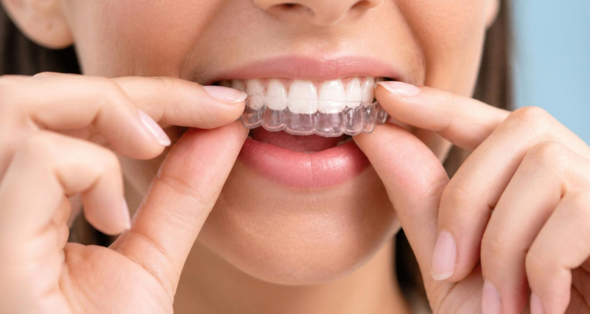 Everything You Need to Know About Invisalign
