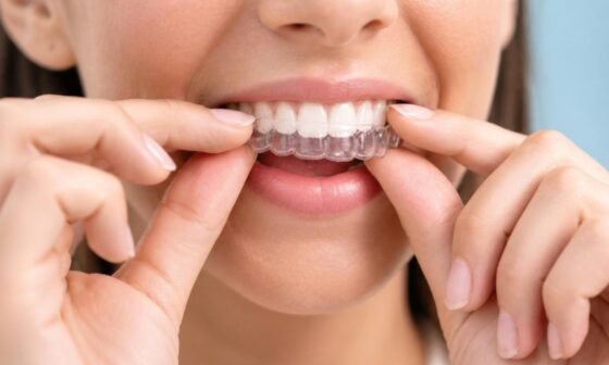 Everything You Need to Know About Invisalign