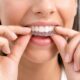 Everything You Need to Know About Invisalign