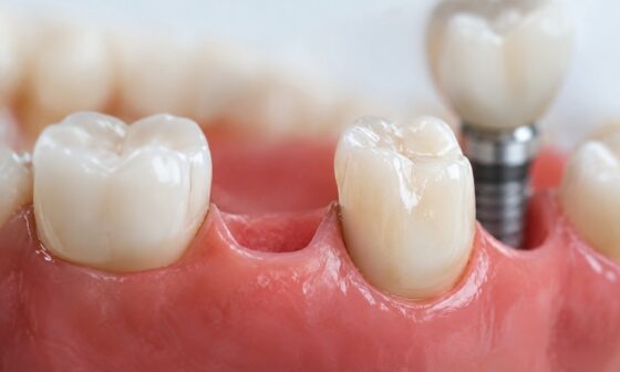 One Missing Tooth Many Choices An Illinois Guide to Restoring Comfort and Confidence