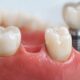 One Missing Tooth Many Choices An Illinois Guide to Restoring Comfort and Confidence