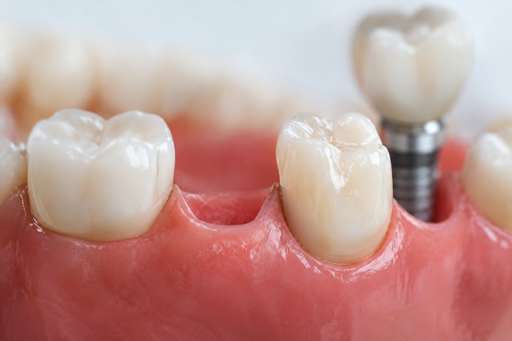 One Missing Tooth Many Choices An Illinois Guide to Restoring Comfort and Confidence